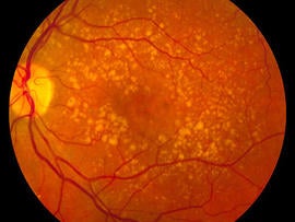 macular degeneration