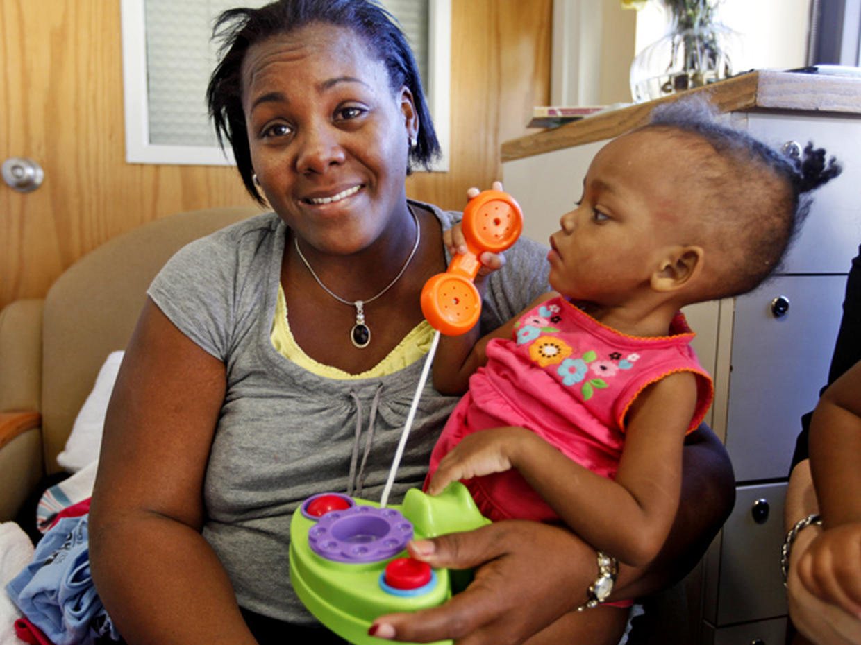 Conjoined twins Maria & Teresa Tapia Before and after Photo 1 CBS News