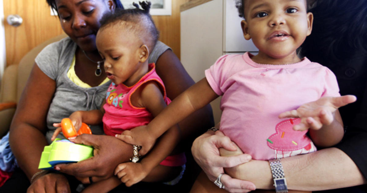 Conjoined twins Maria & Teresa Tapia Before and after Photo 1 CBS News