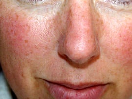 rosacea, flushed, face, red, skin