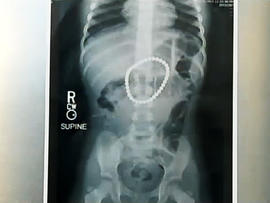 x-ray, buckyballs, swallow magnets