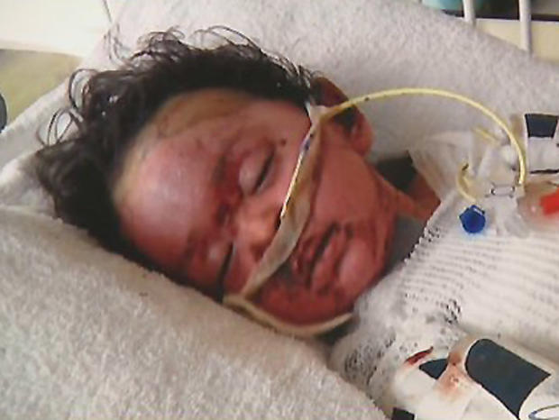Toddler Burned By Boiling Water 