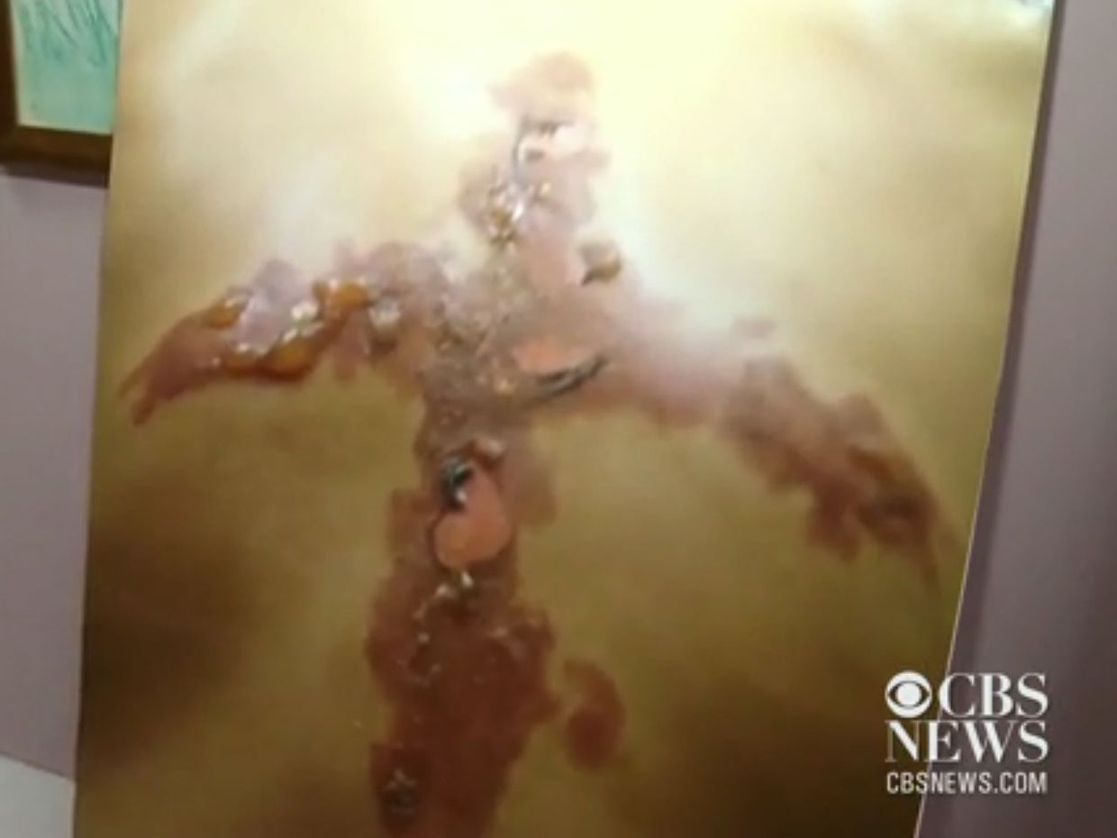 "Ice and salt challenge" leaves 12yearold Pittsburgh boy with second