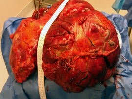 51-pound tumor
