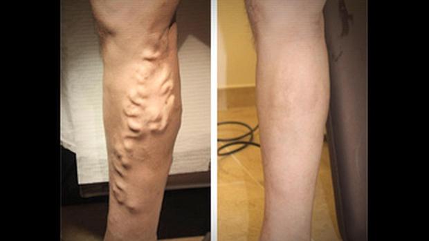 Varicose Vein Treatment Before and After 