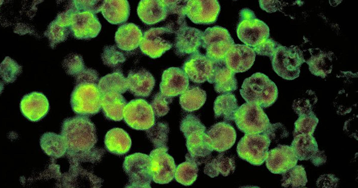 Rare case of brain-eating amoeba confirmed in Florida - CBS News