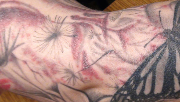 Tattoo ink causes health scare: How to identify infection 