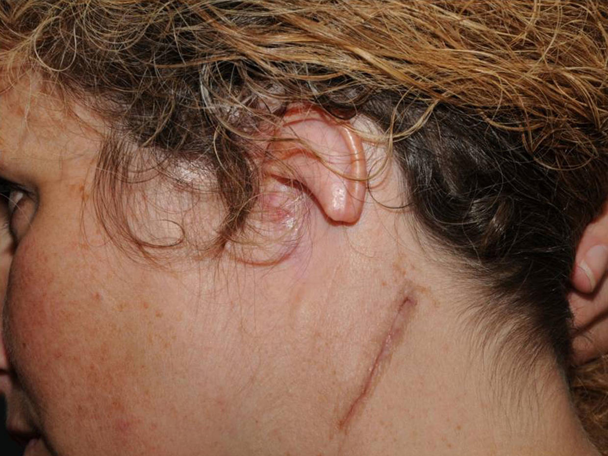 Ear Reconstruction Surgery Graphic Photos Cbs News