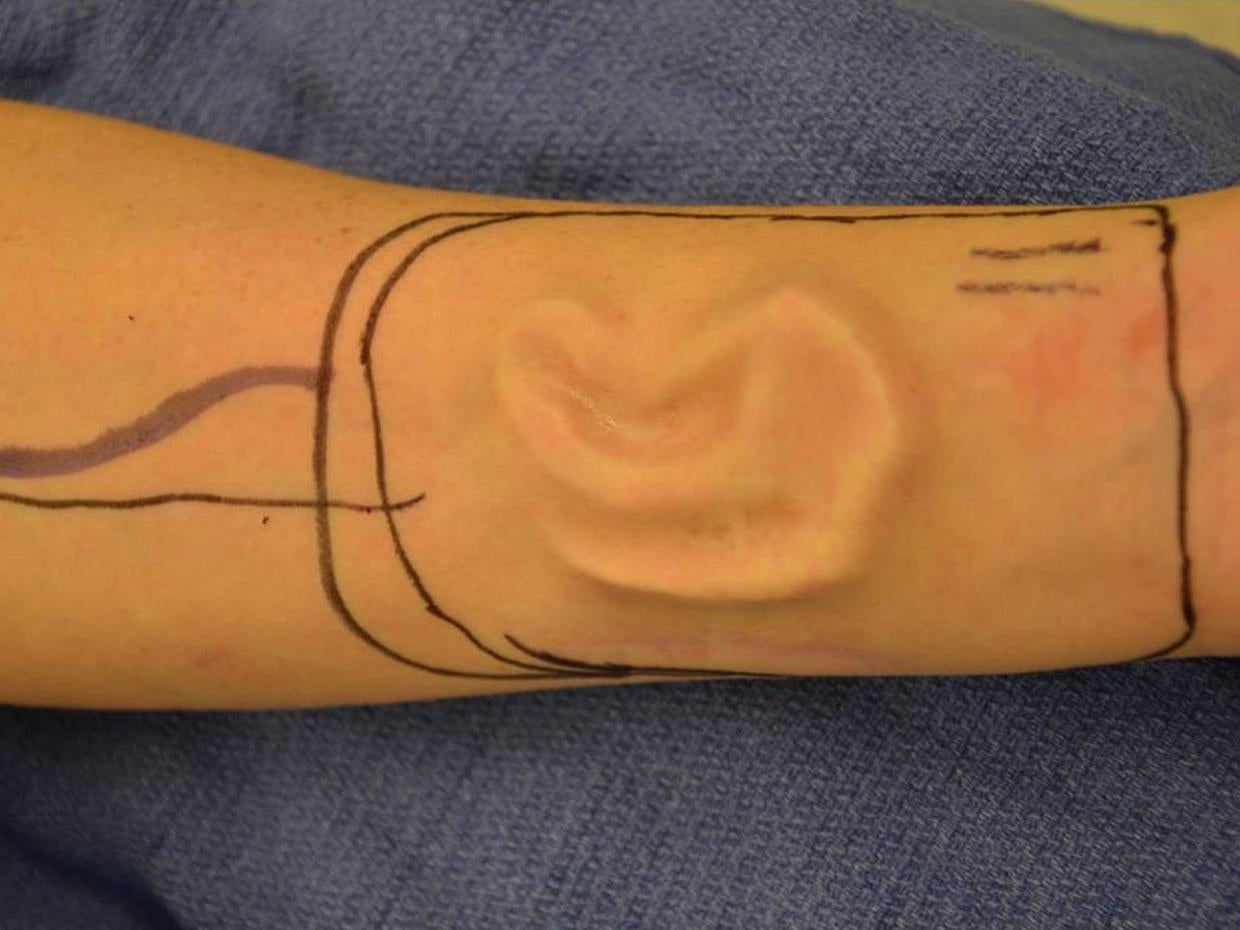 Ear reconstruction surgery (Graphic Photos) Photo 1 CBS News