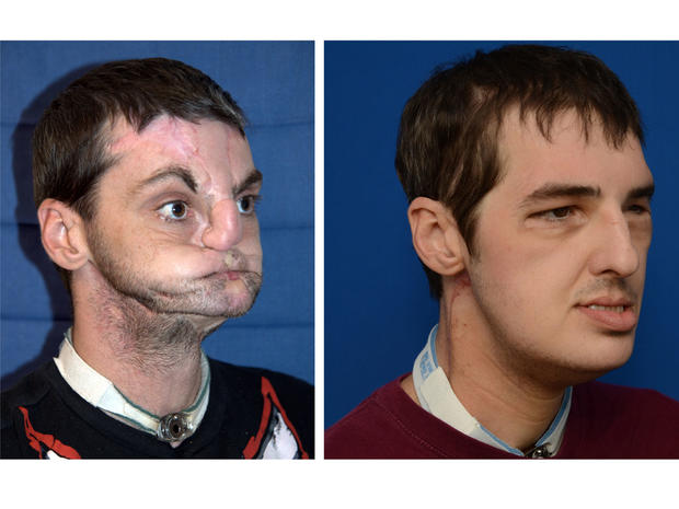 face transplant, richard lee norris, university of maryland medical center 