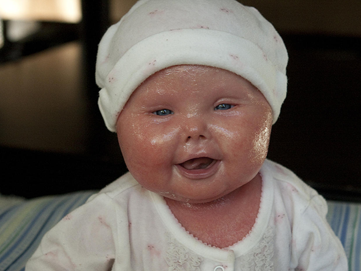 Meet Brenna, a baby with Harlequin Ichthyosis - Photo 9 ...