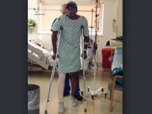 Louisville G Kevin Ware up and moving on crutches today after surgery to repair a broken leg yesterday