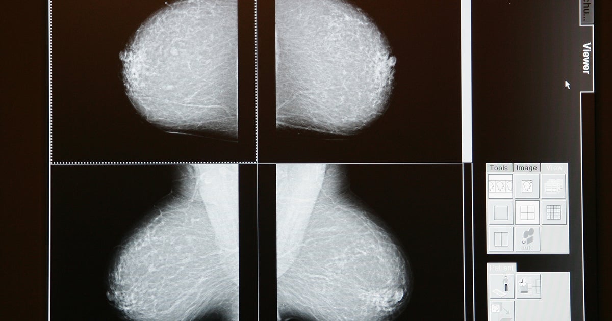 Persistent pain a problem year after breast cancer surgery CBS News