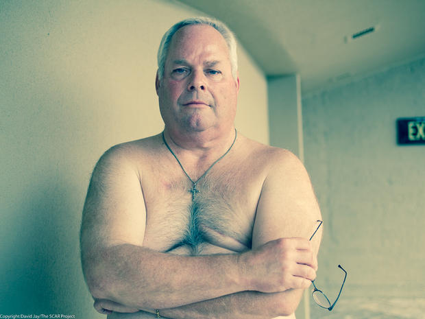 The SCAR Project - Picturing male breast cancer - Pictures 