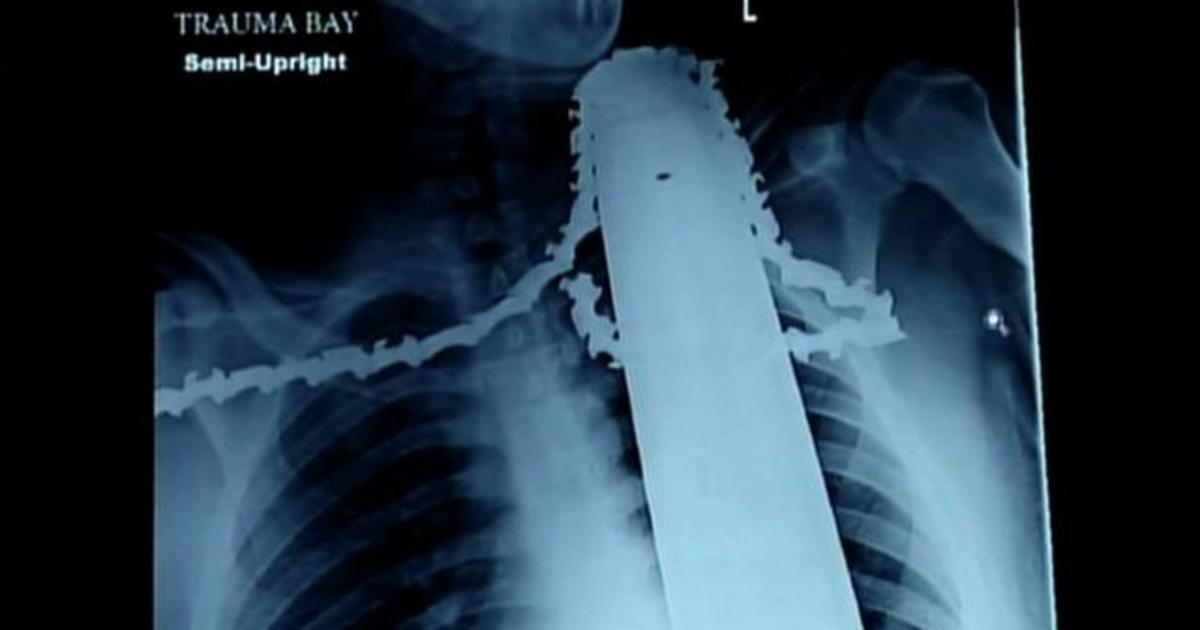 Chainsaw Gets Stuck In Man S Neck In Freak Accident Cbs News