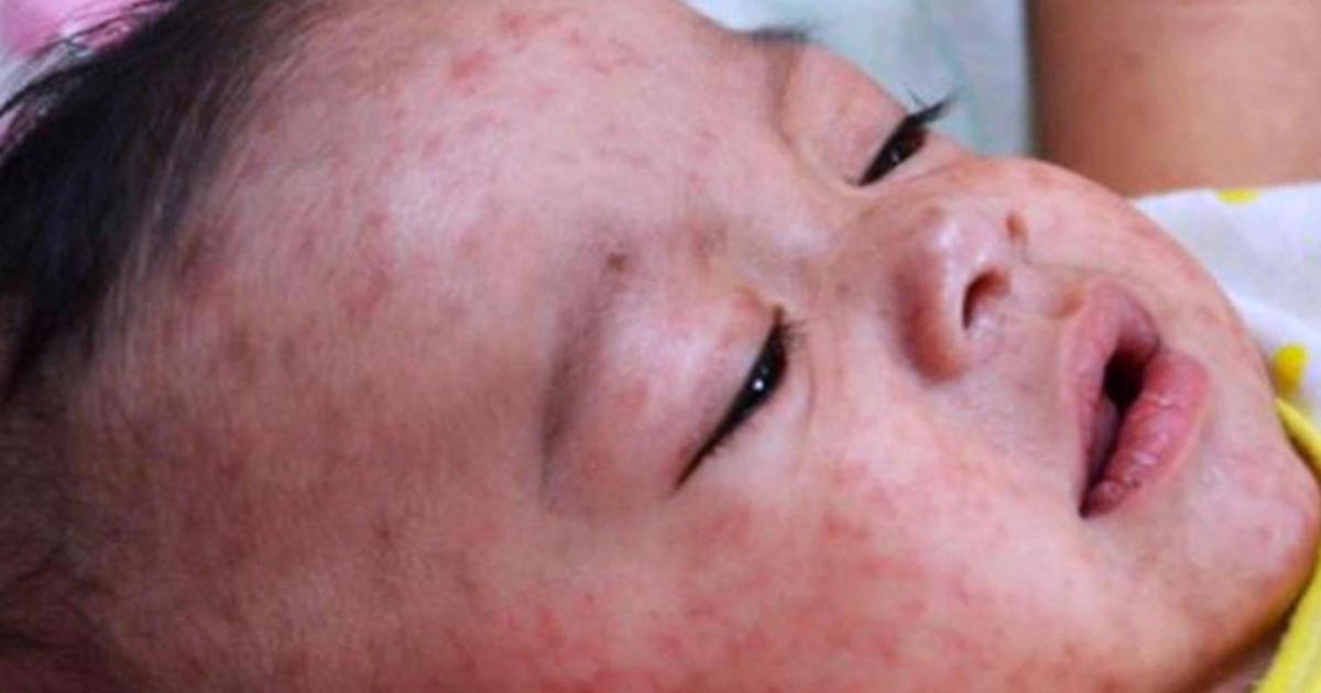 Measles outbreak traced to Disneyland continues to grow 