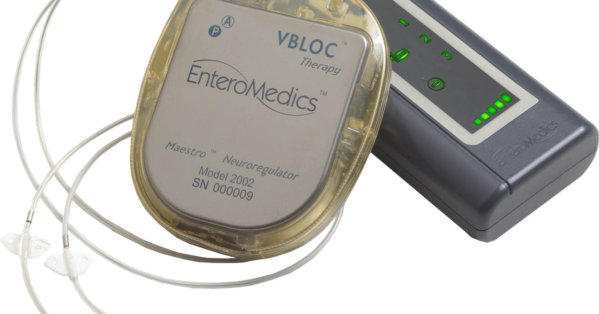 FDA approves new kind of device to treat obesity CBS News