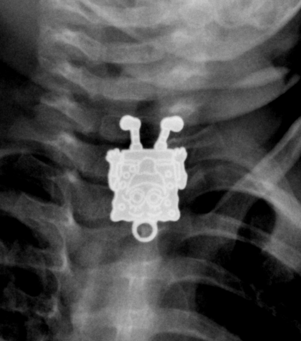 ingested-foreign-body-spongebob-squarepants.png