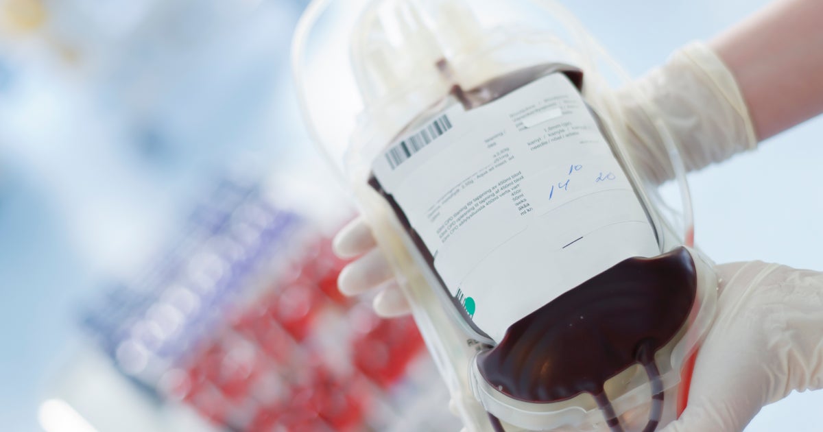 Cordblood transplants show promise in leukemia treatment CBS News