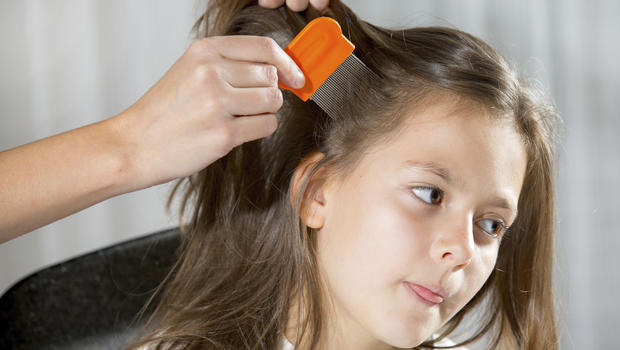 Super Lice Not Budging With Over The Counter Treatments Cbs News 6736