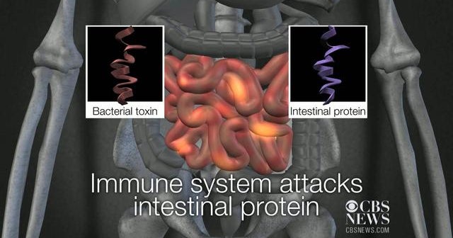 New blood test for IBS CBS News