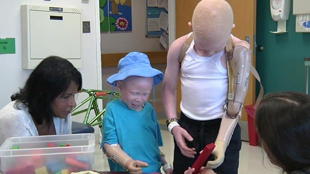 albinism.jpg