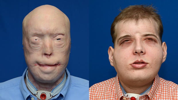 patrick-hardison-before-and-after.jpg