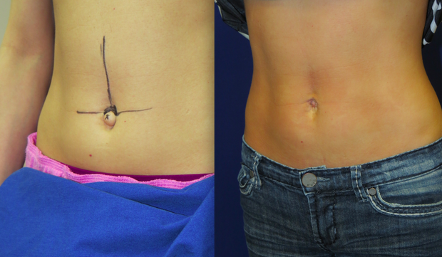 Belly Buttons The Tiny Little Body Part People Want Plastic Surgery On
