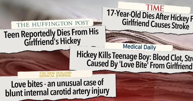 Deadly hickey kills teenager CBS News