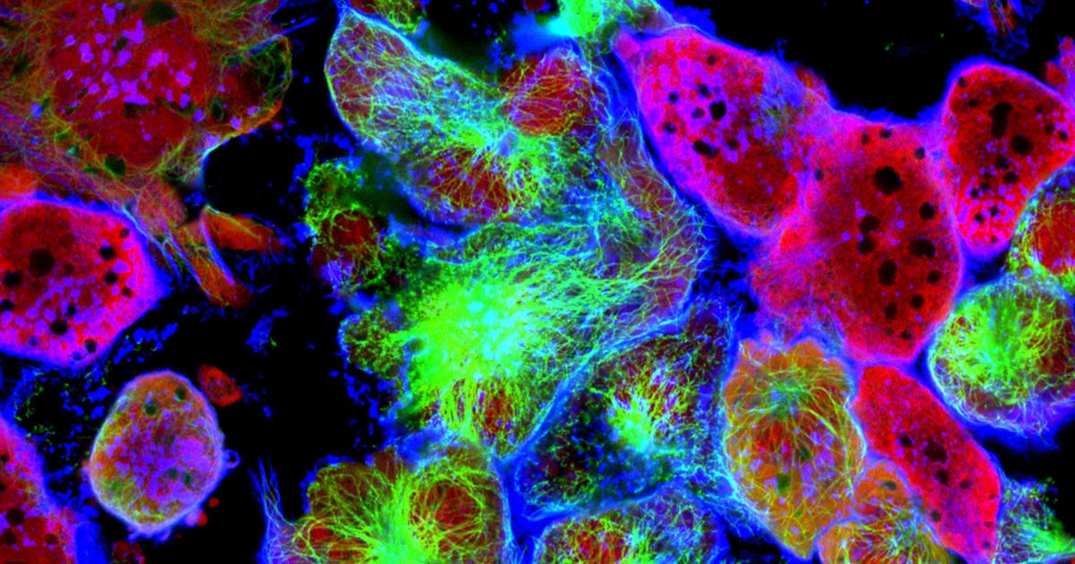 random-mutations-blamed-for-big-role-cancer-cbs-news