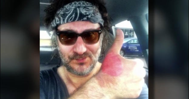 Minnesota man burned squeezing limes in the sun CBS News