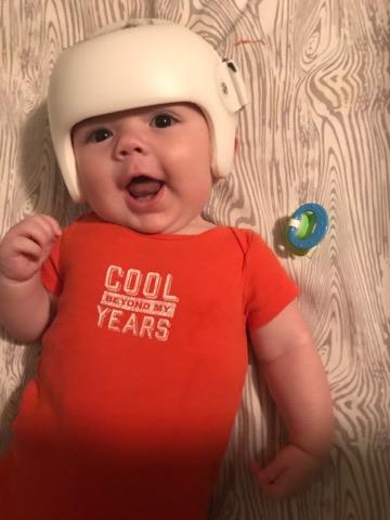 Family sports helmets after baby gets diagnosed with flat