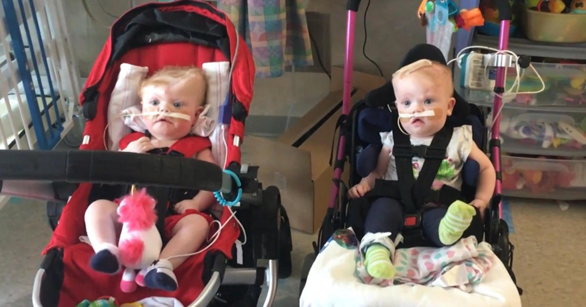 Recently Separated Conjoined Twins Getting Ready To Go Home Cbs News 2965