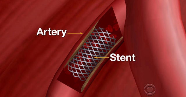 Do stents ease chest pain?