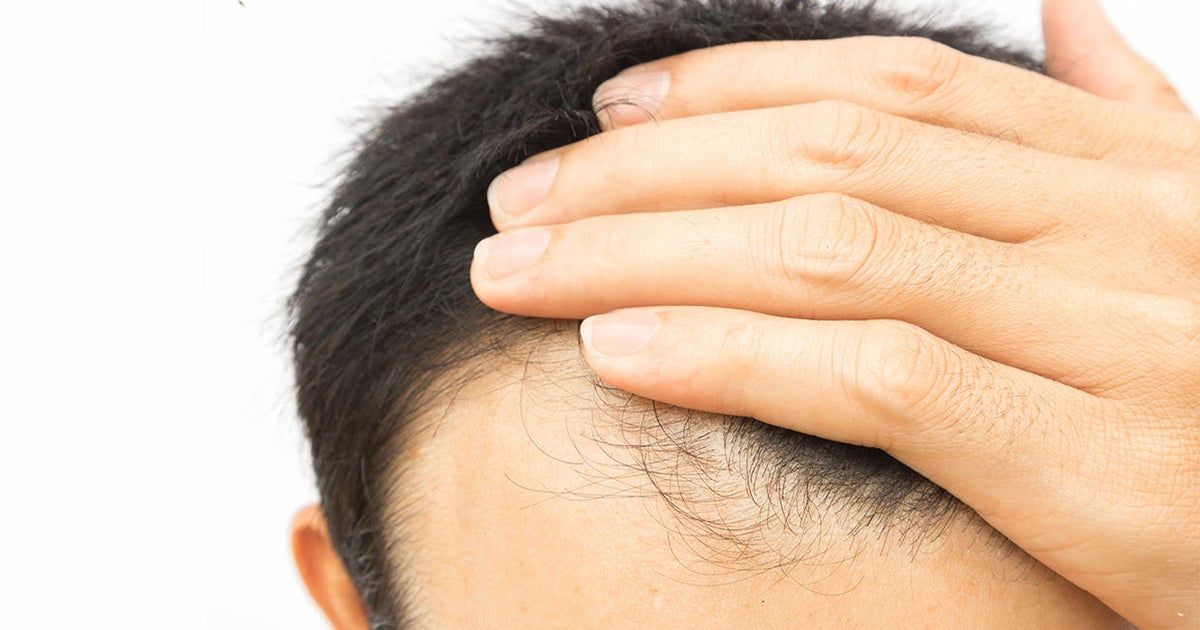 Could early balding signal heart trouble in men? CBS News