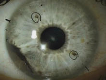ocular-melanoma-eye-cancer-promo.jpg 