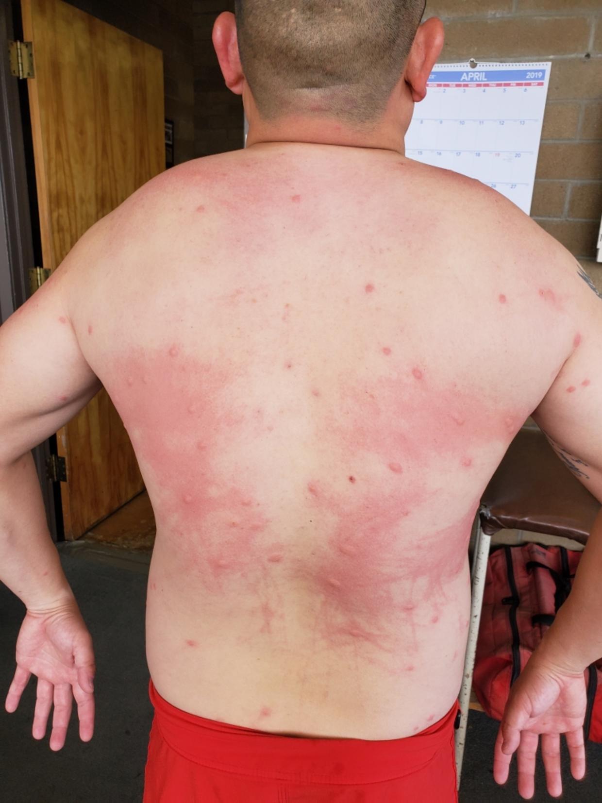 Skin Rash After Swimming In Ocean