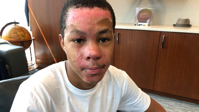 Chemistry Class Student Burned 