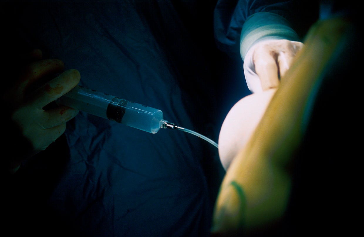 Most expensive medical procedures in the U.S., without insurance CBS News
