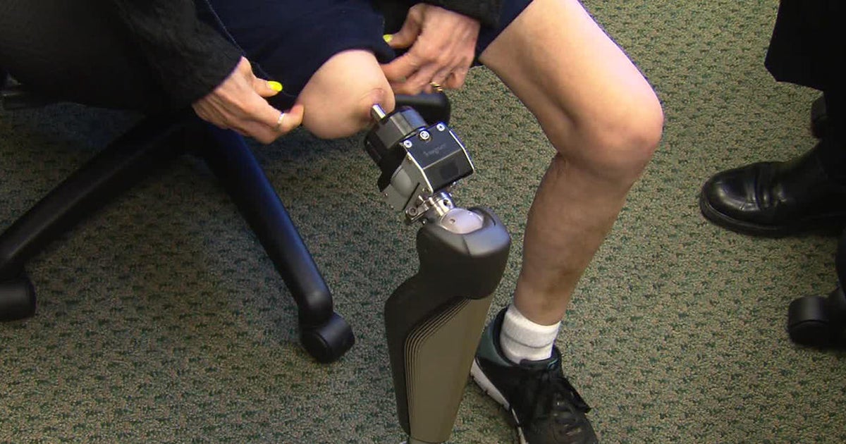 A giant step forward for users of artificial legs CBS News