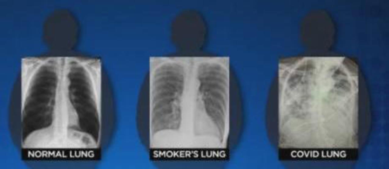 normal-smokers-covid-chest-x-rays.jpg