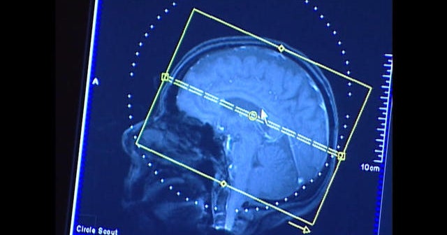 Millions spent on unnecessary brain scans