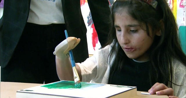 Afghan girl receives prosthetic arm in U.S.