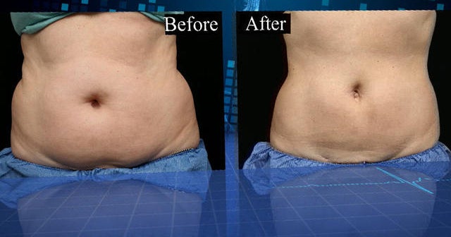 Freezing fat cells: Coolsculpting claims to remove fat without surgery
