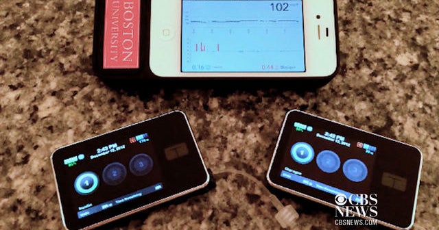 Bionic pancreas uses smartphone to control blood sugar