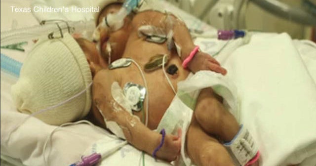 Conjoined twin girls to be separated in Texas