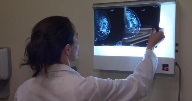Breast cancer patients often must undergo many surgeries, study finds