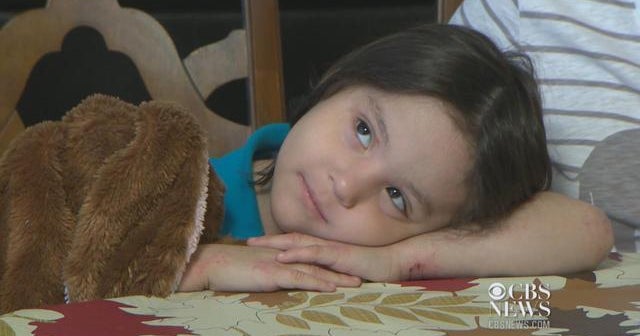 New guidelines released for treating kids with eczema