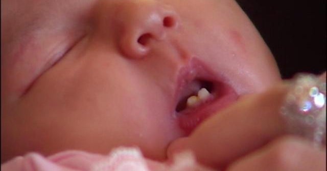 Baby born with two front teeth
