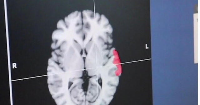 Siblings with autism have different genetic mutations